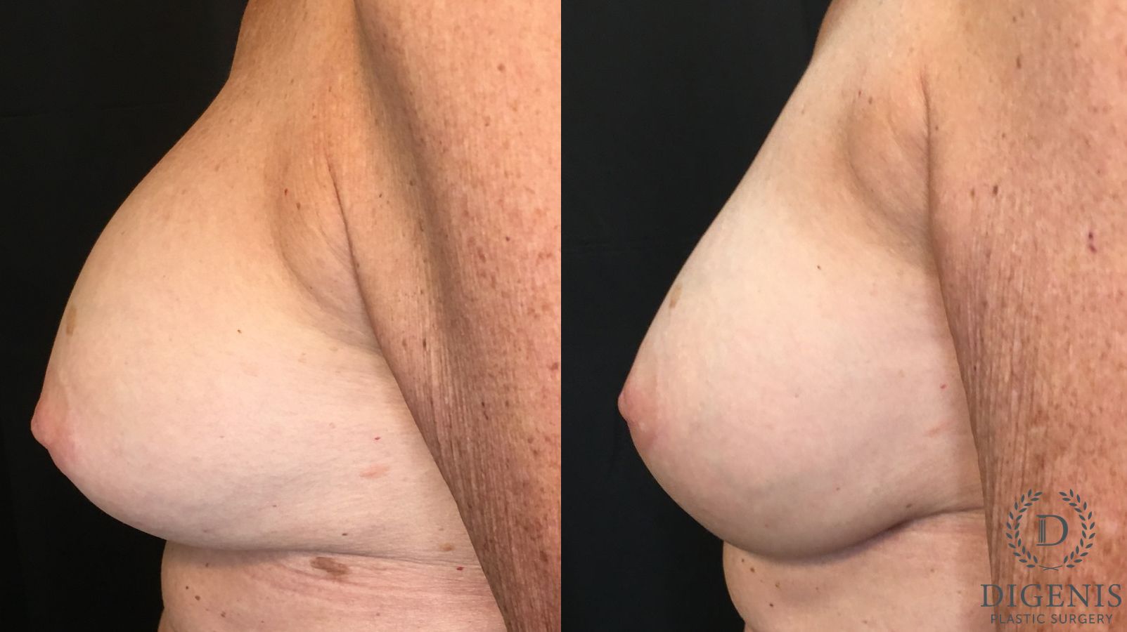 Before and after Breast Implant Exchange case 35159 - Angle 5