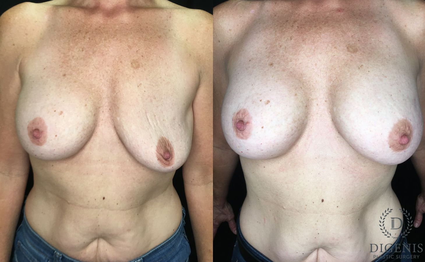 Before and after Breast Implant Exchange case 35188