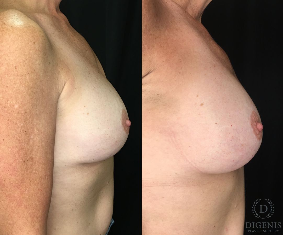 Before and after Breast Implant Exchange case 35188 - Angle 3