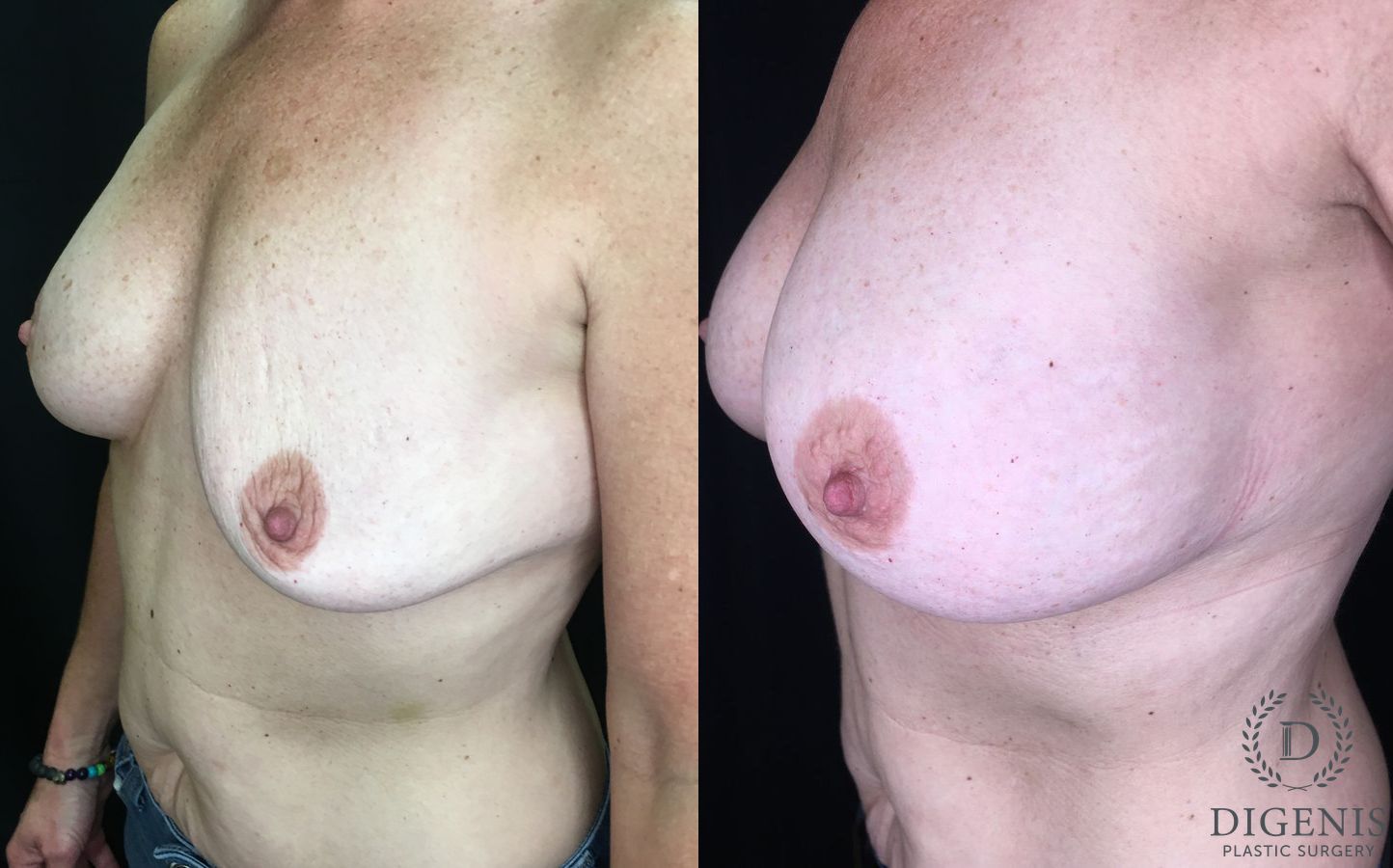 Before and after Breast Implant Exchange case 35188 - Angle 4