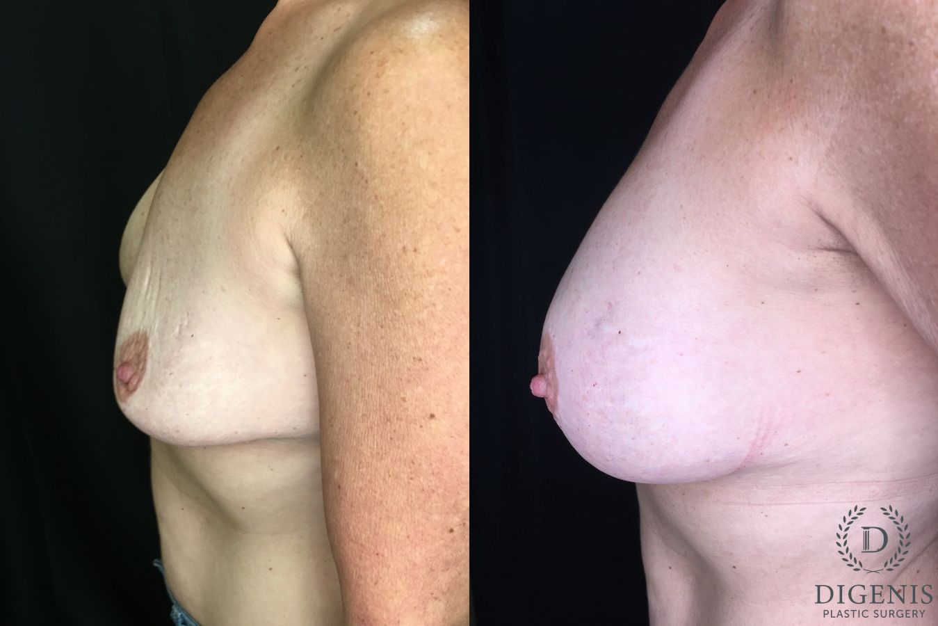 Before and after Breast Implant Exchange case 35188 - Angle 5