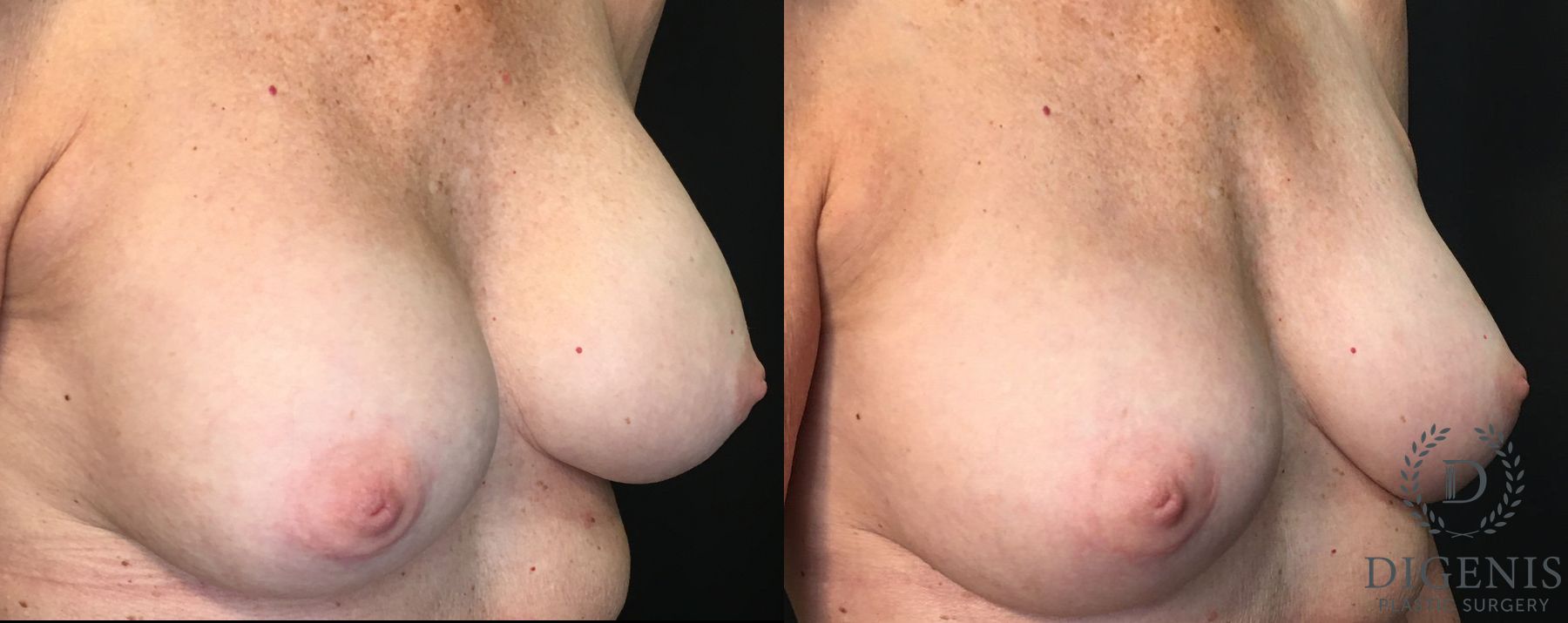 Before and after Breast Implant Exchange case 35159 - Angle 2