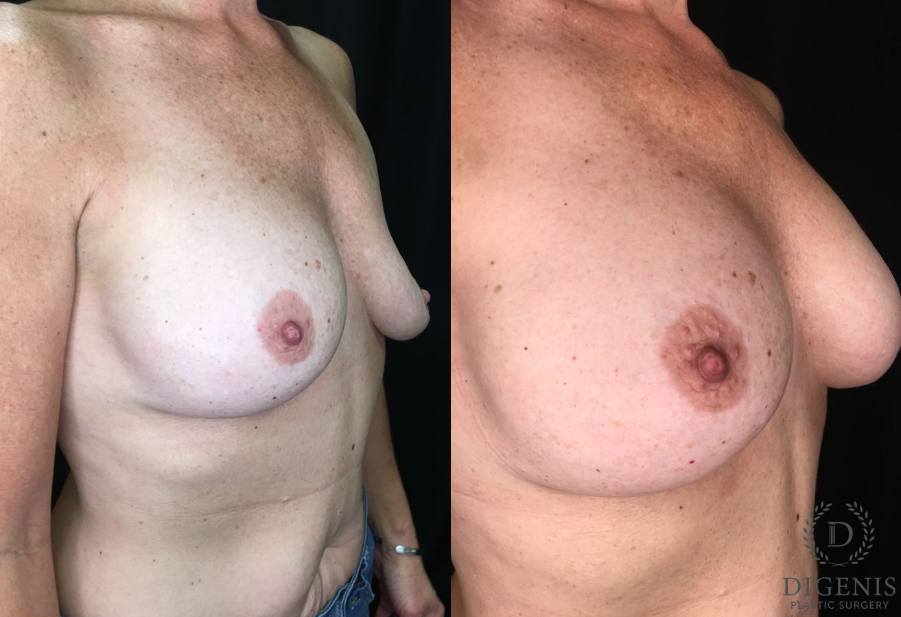 Before and after Breast Implant Exchange case 35188 - Angle 2