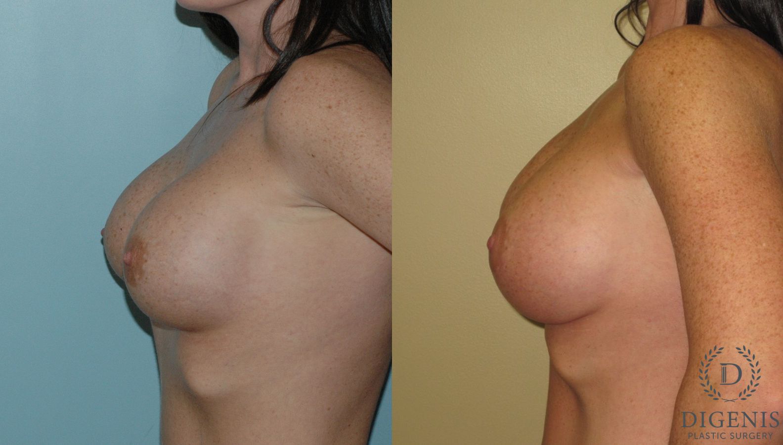 Before and after Breast Implant Exchange or Removal case 35125 - Angle 3