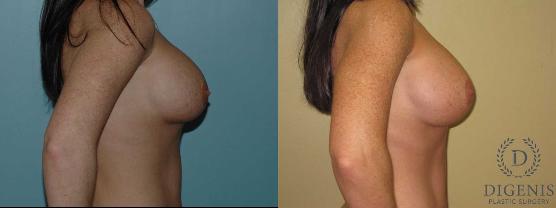 Before and after Breast Implant Exchange or Removal case 35125 - Angle 2