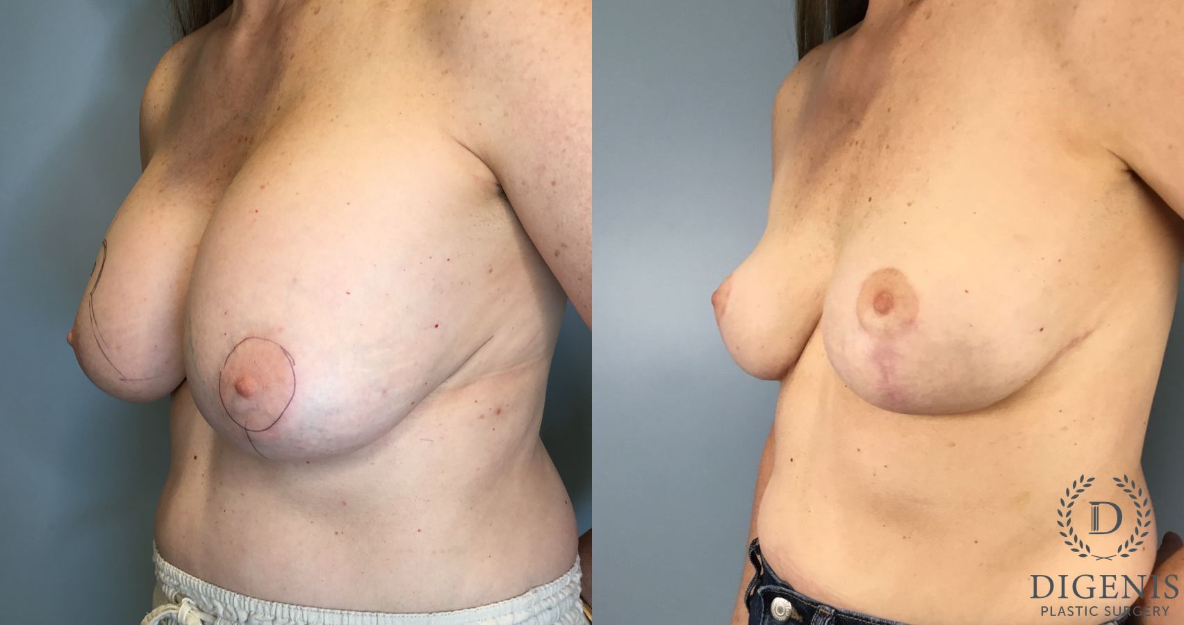 Before and after Breast Implant Exchange or Removal case 41691 - Angle 2