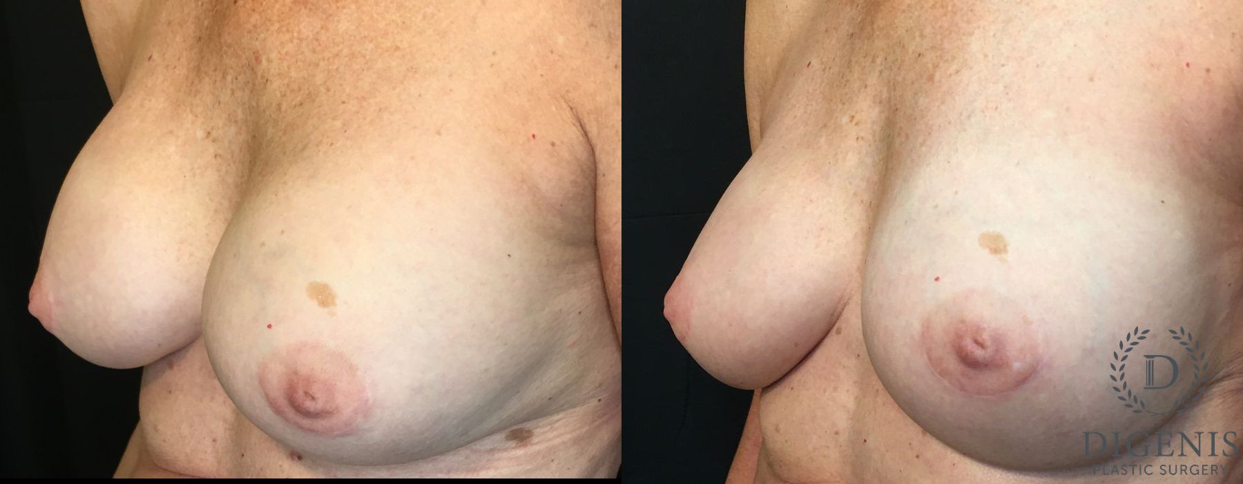 Before and after Breast Implant Exchange or Removal case 35159 - Angle 4