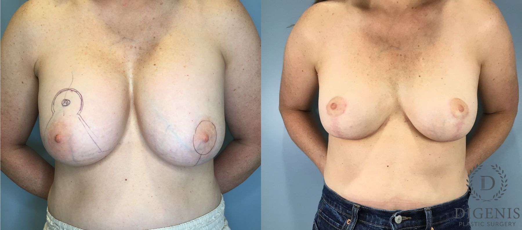 Before and after Breast Implant Exchange or Removal case 41691