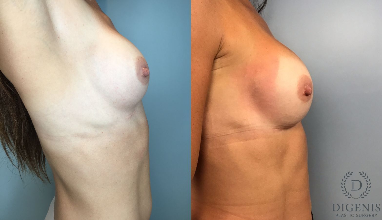 Before and after Breast Implant Exchange or Removal case 46418 - Angle 4