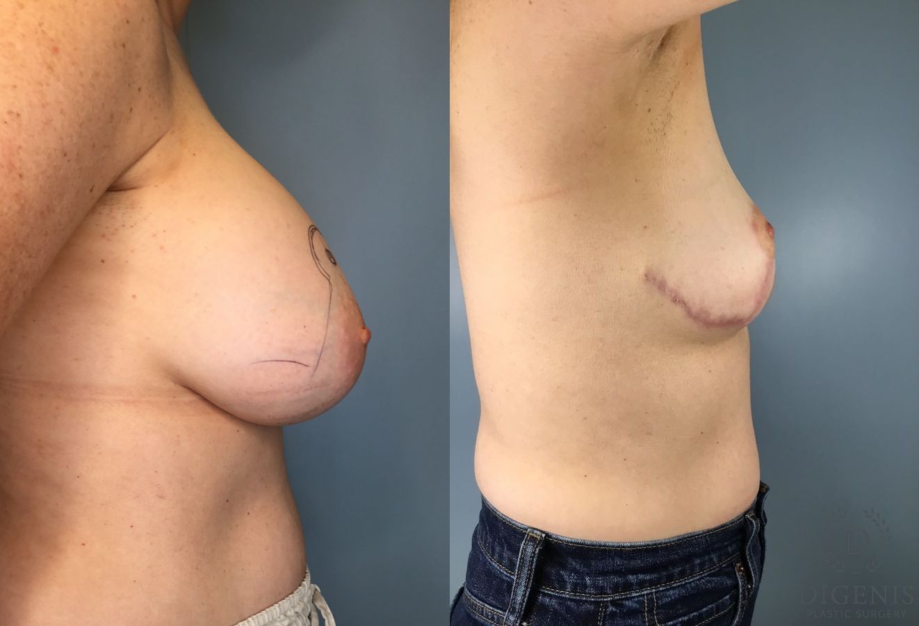 Before and after Breast Implant Exchange or Removal case 41691 - Angle 4