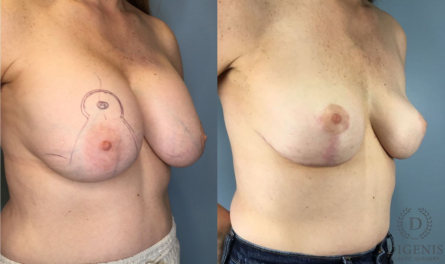 Before and after Breast Implant Exchange or Removal case 41691 - Angle 3