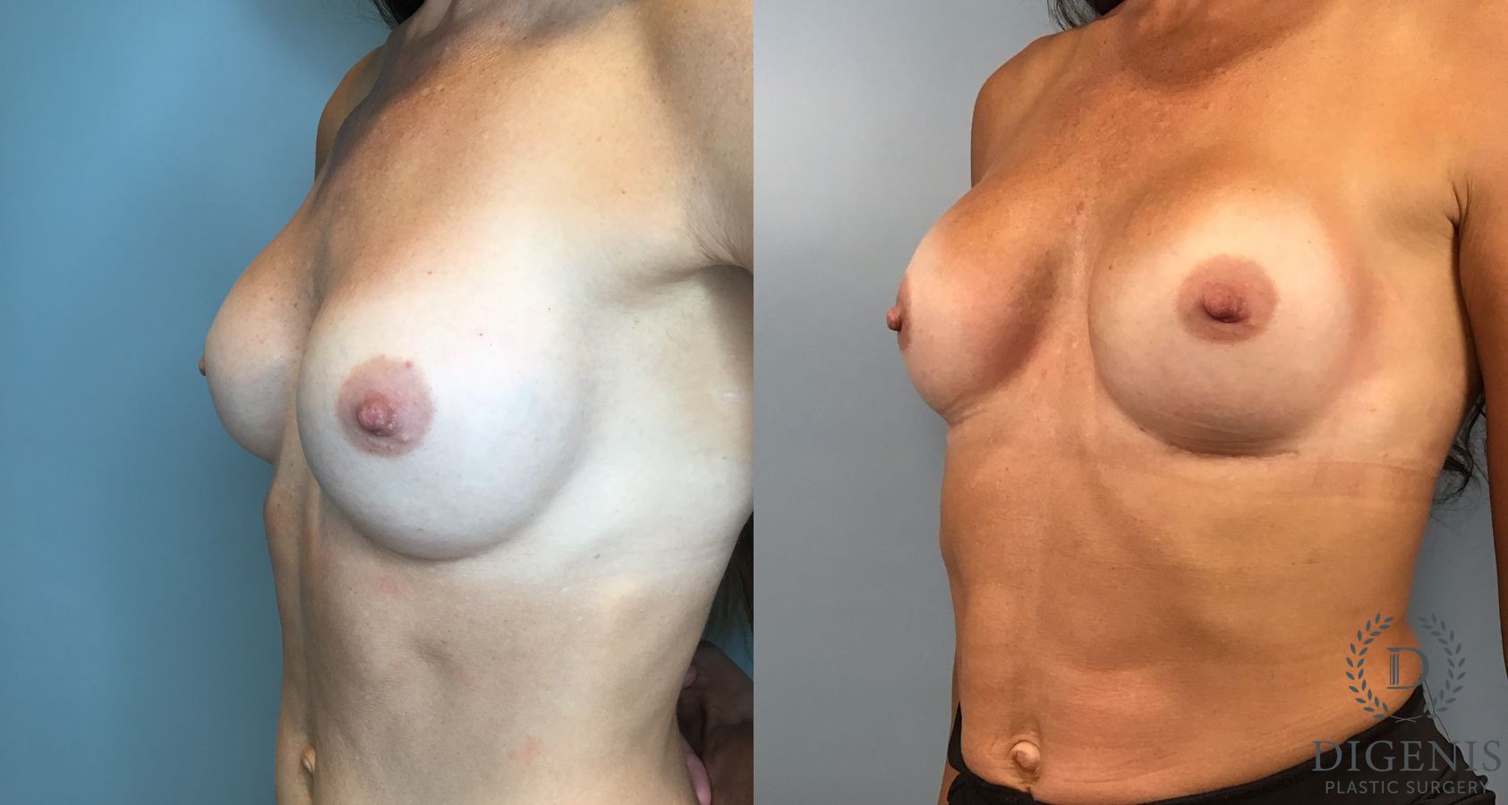 Before and after Breast Implant Exchange or Removal case 46418 - Angle 2