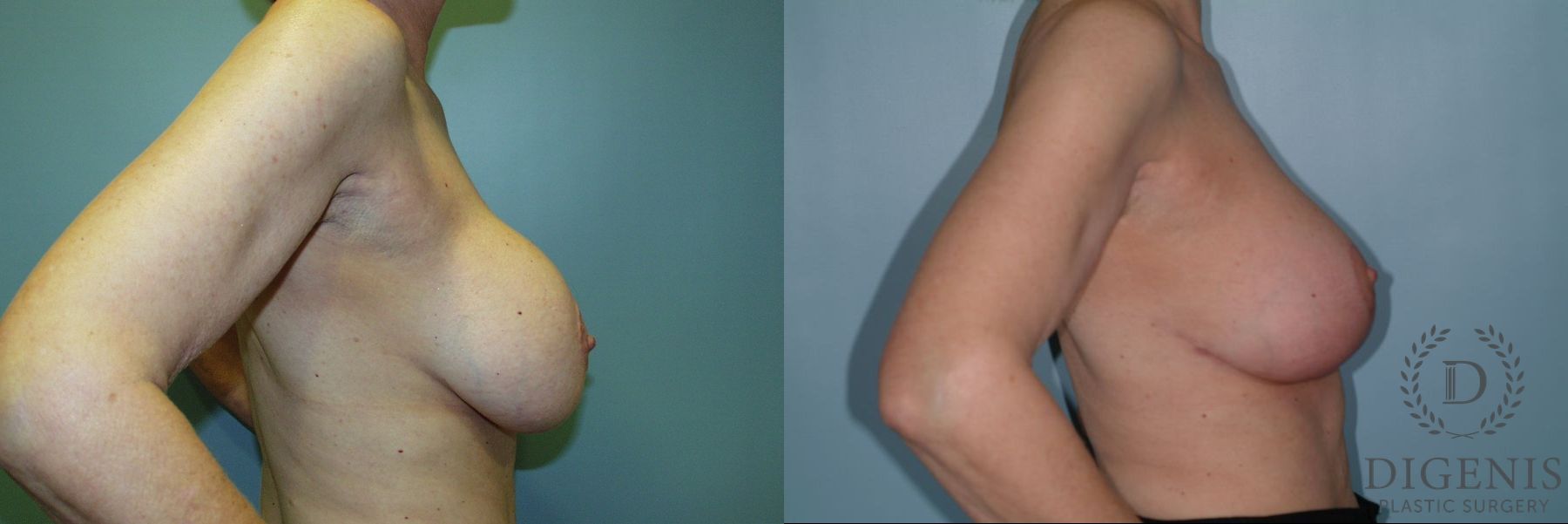 Before and after Breast Lift with or without Implants case 35107 - Angle 3