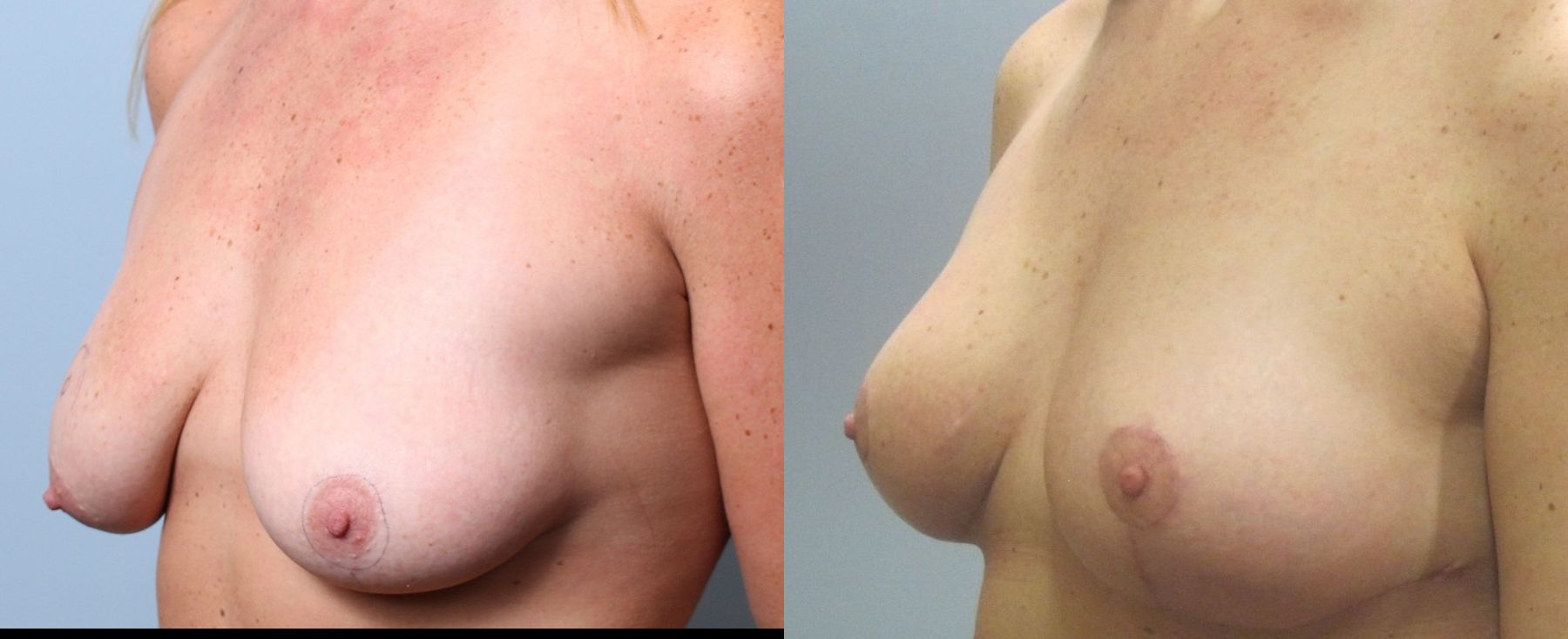 Before and after Breast Lift with or without Implants case 35132 - Angle 4