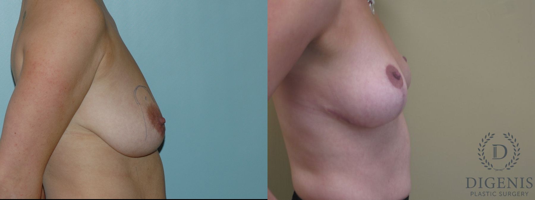 Before and after Breast Lift with or without Implants case 35098 - Angle 2