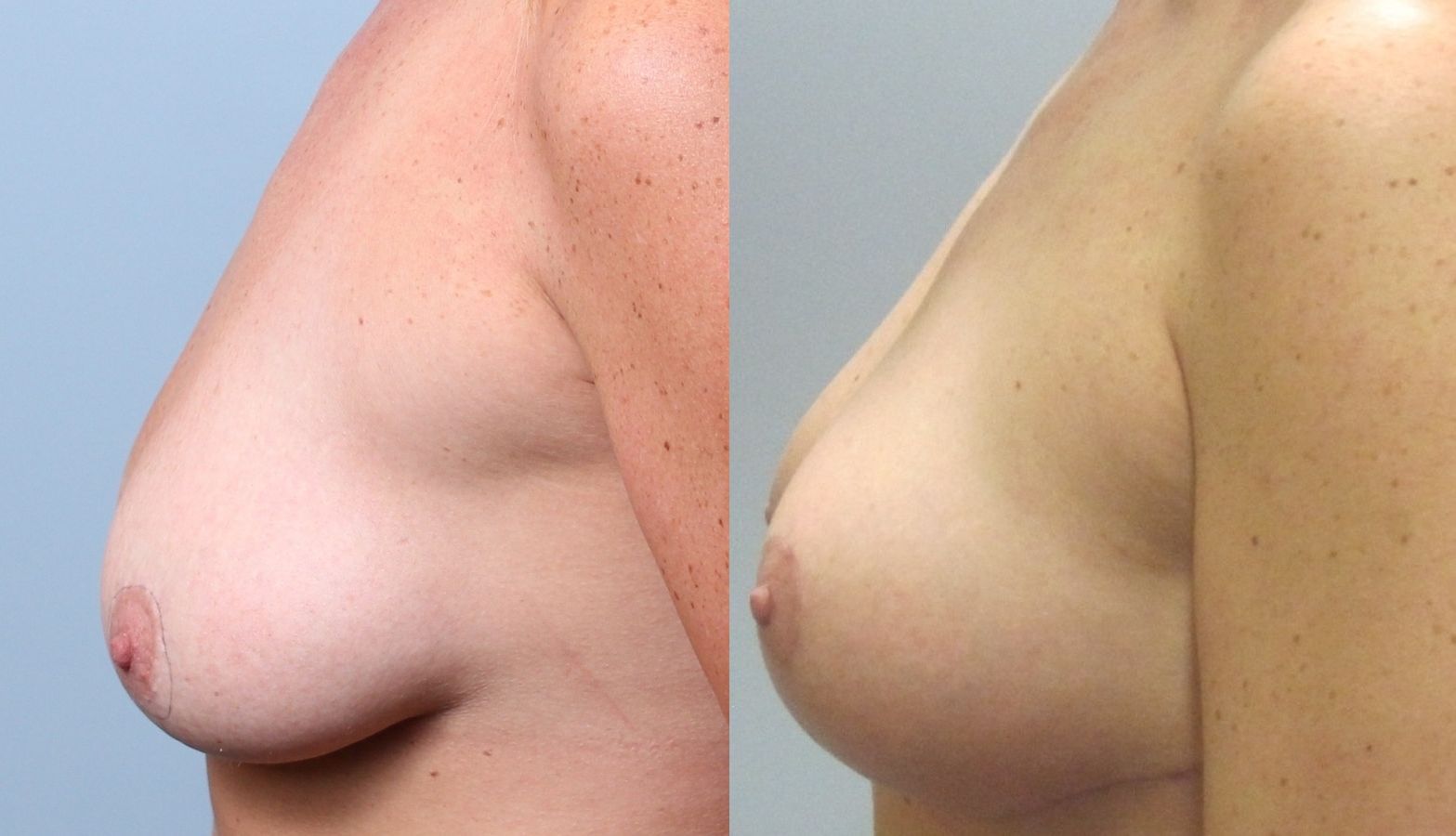 Before and after Breast Lift with or without Implants case 35132 - Angle 5