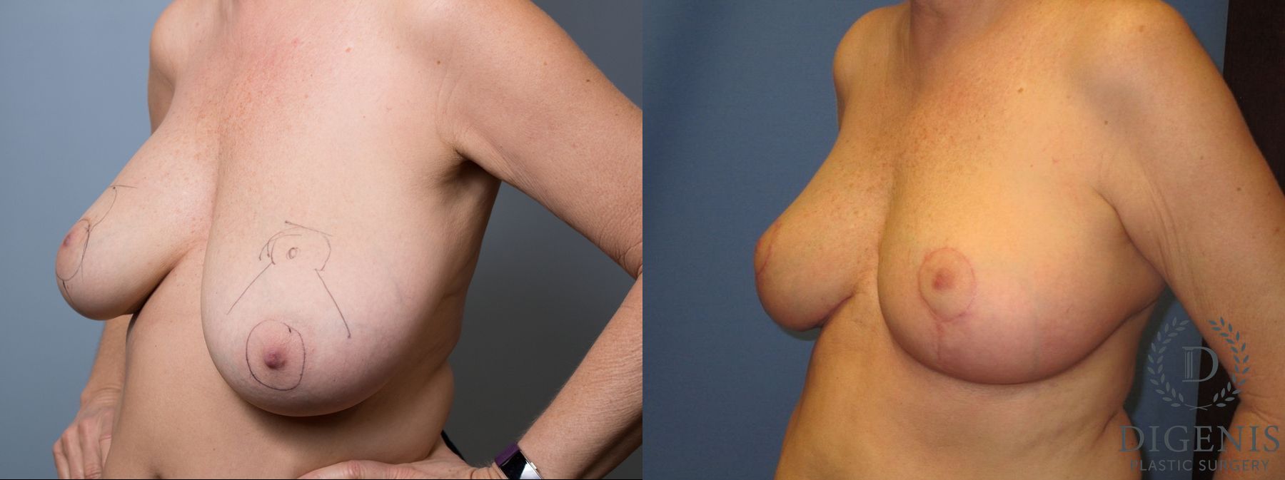 Before and after Breast Lift with or without Implants case 35133 - Angle 4
