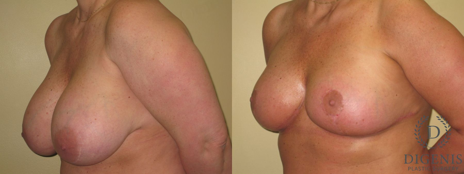 Before and after Breast Lift with or without Implants case 35105 - Angle 4