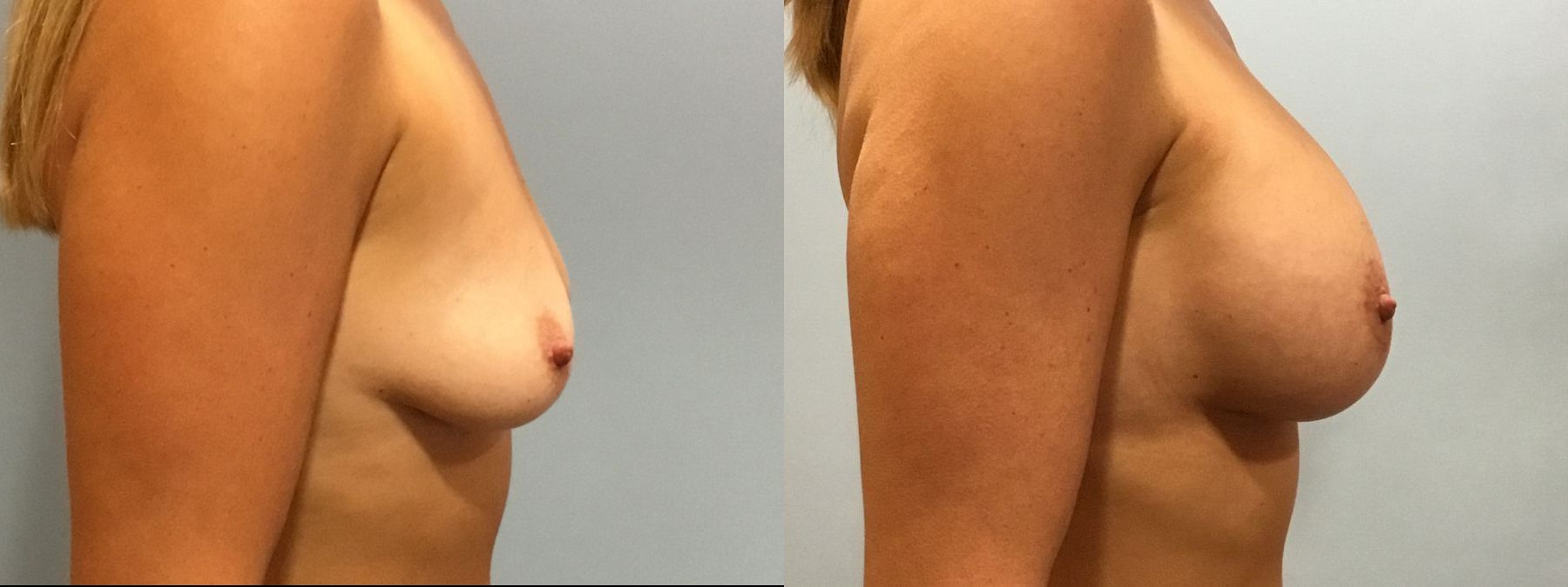 Before and after Breast Lift with or without Implants case 35093 - Angle 3