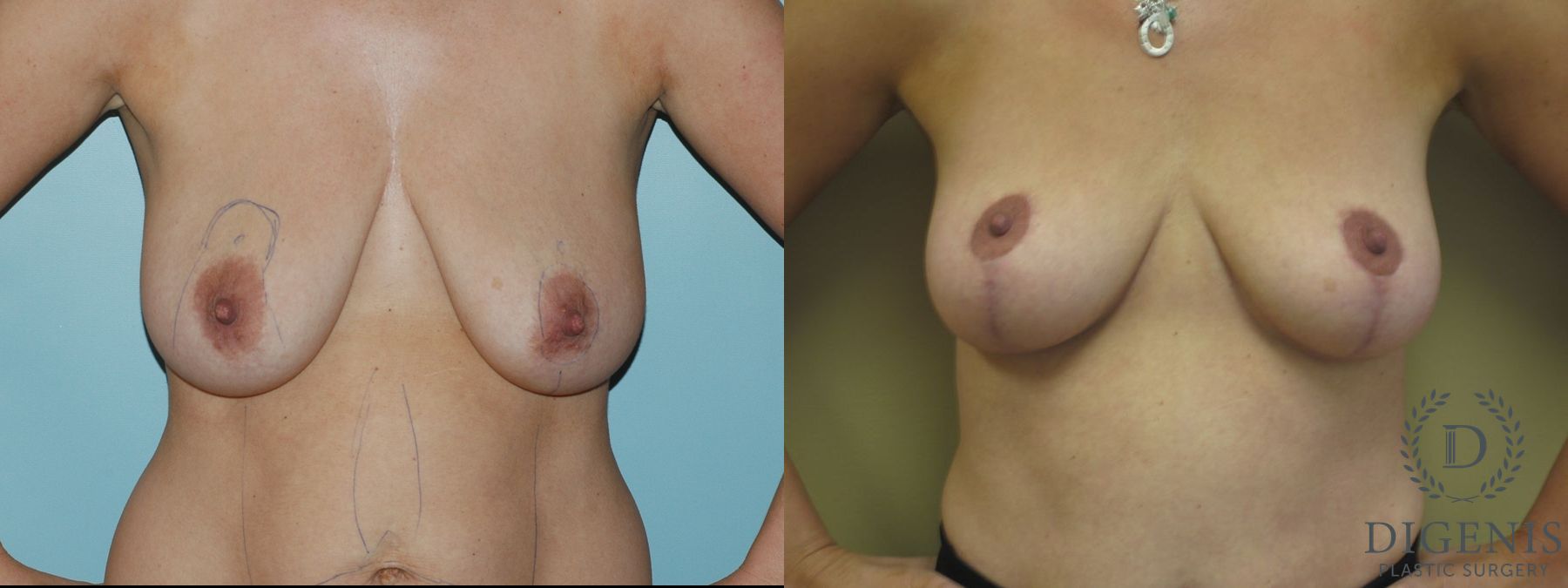 Before and after Breast Lift with or without Implants case 35098