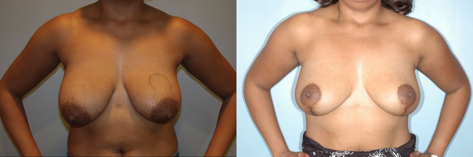 Before and after Breast Lift with or without Implants case 35083