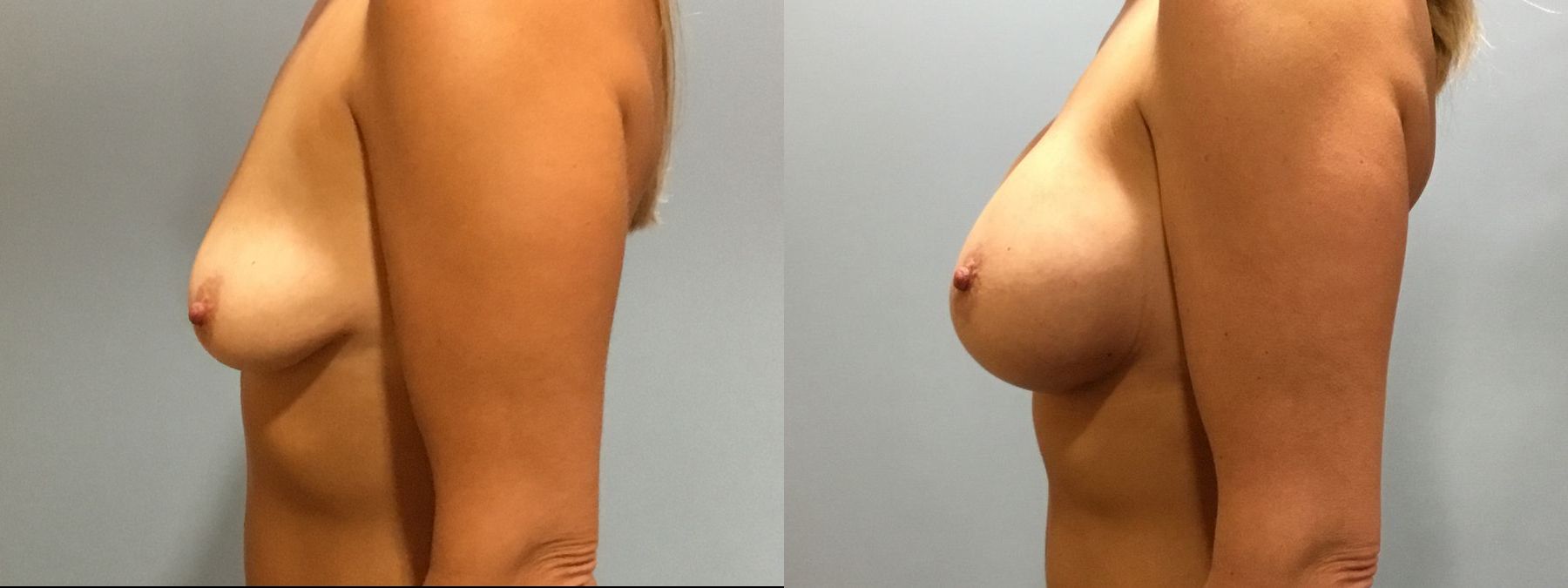 Before and after Breast Lift with or without Implants case 35093 - Angle 5
