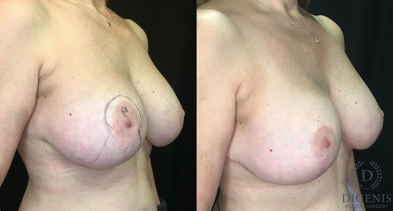 Before and after Breast Lift with or without Implants case 35156 - Angle 2