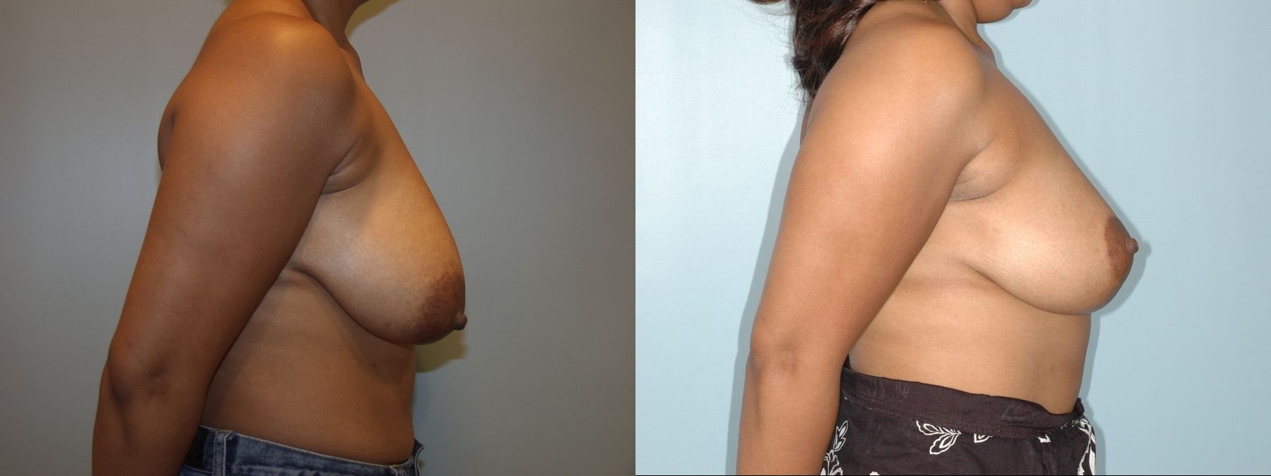 Before and after Breast Lift with or without Implants case 35083 - Angle 2