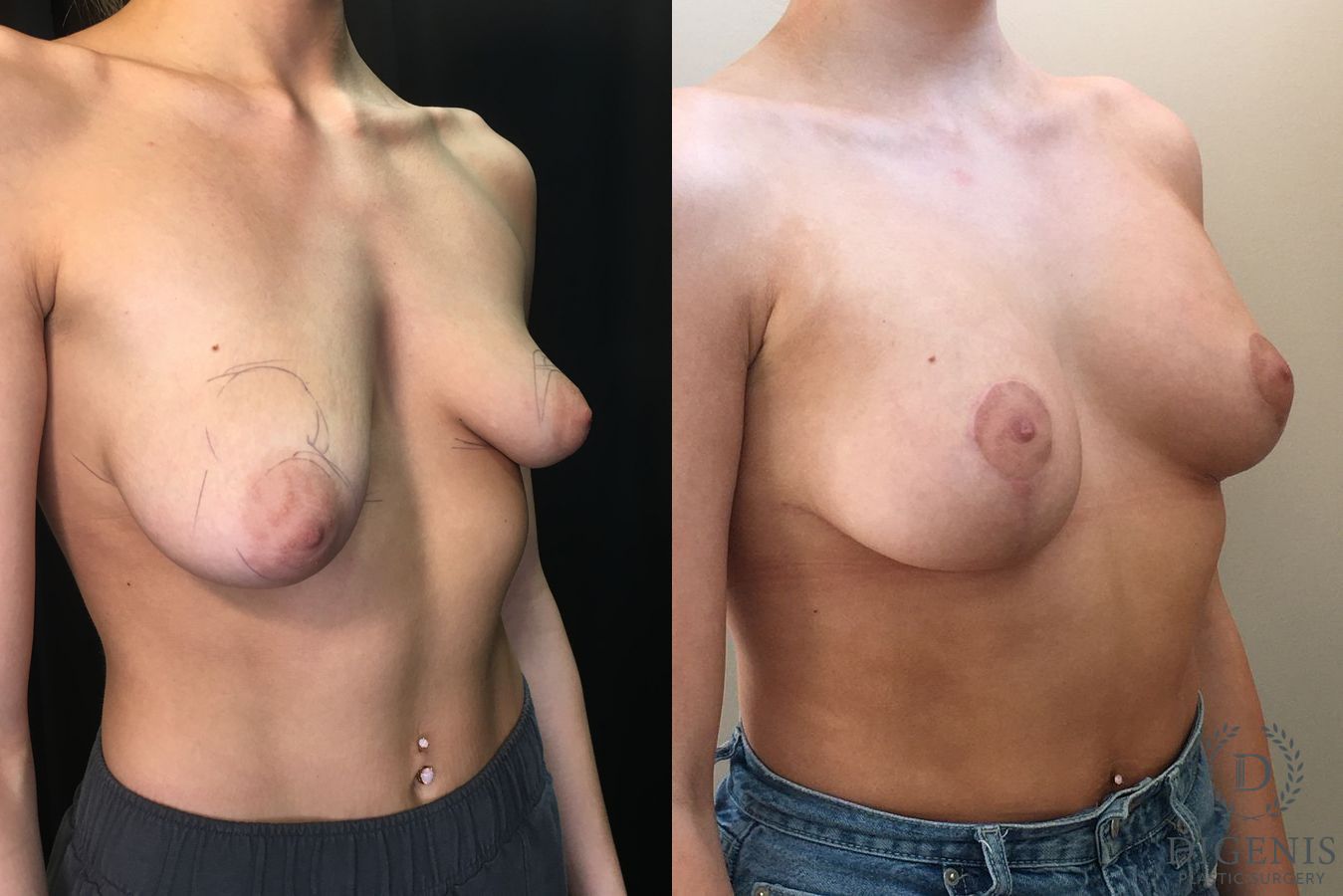Before and after Breast Lift with or without Implants case 35195 - Angle 2