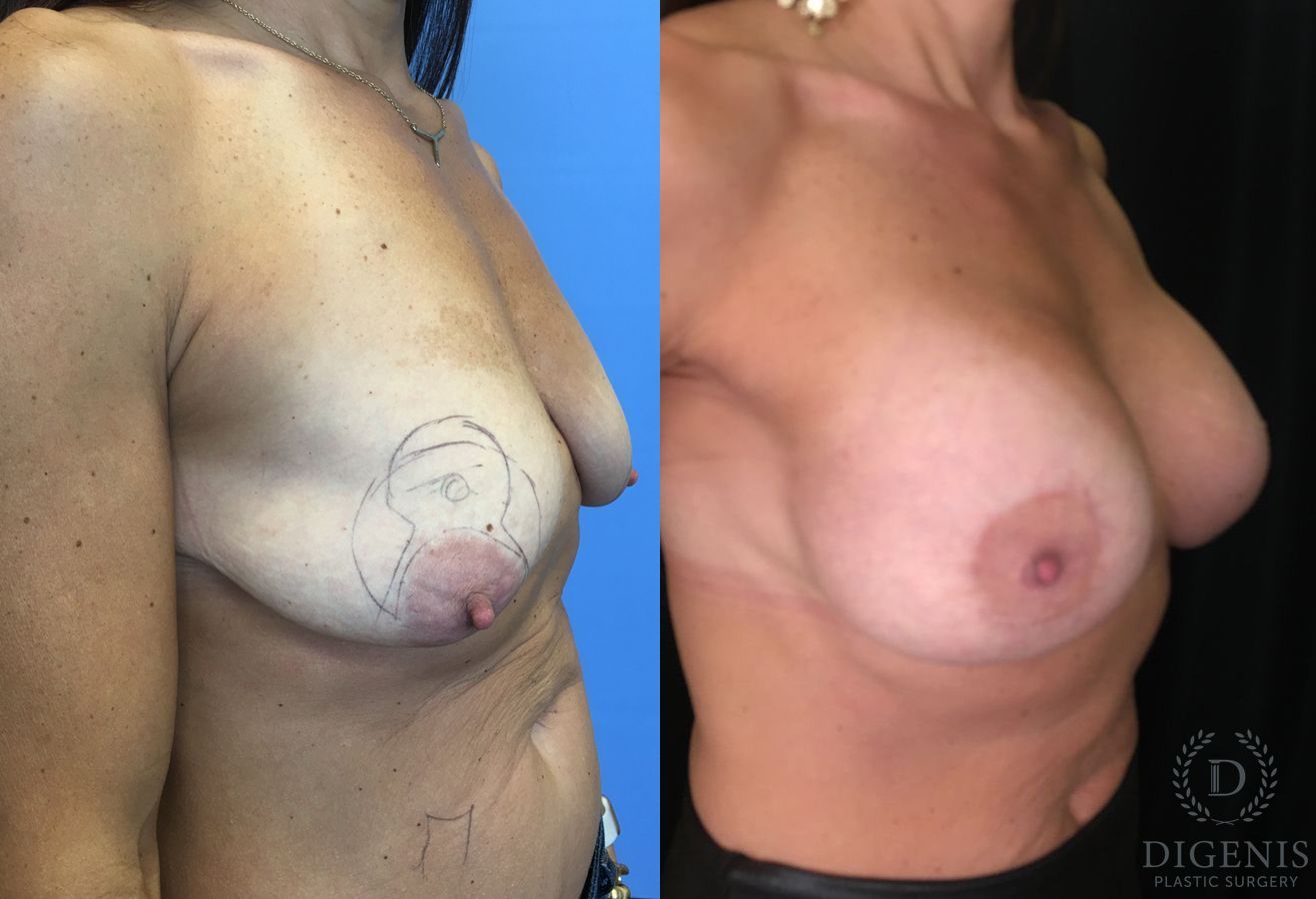 Before and after Breast Lift with or without Implants case 35196 - Angle 2