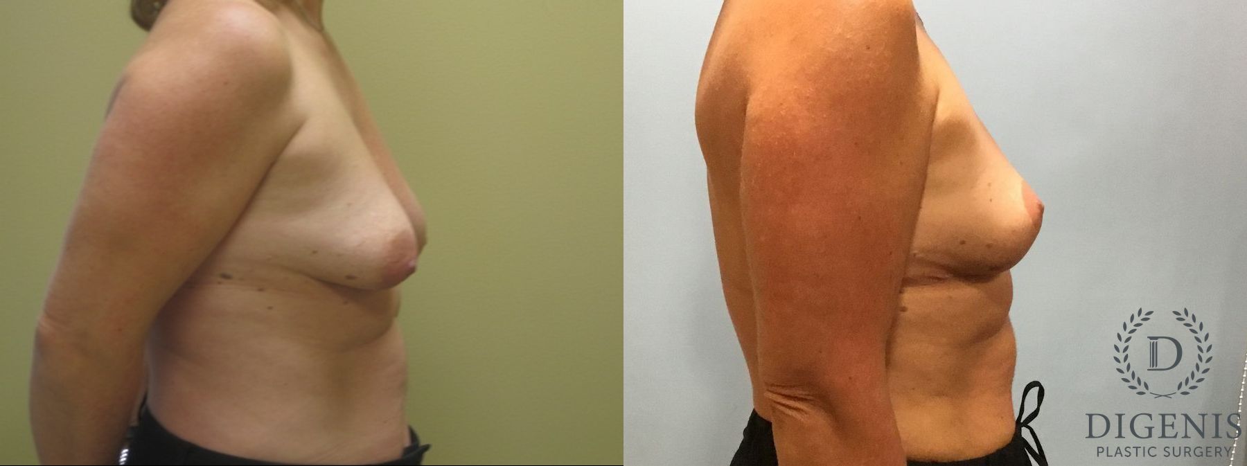 Before and after Breast Lift with or without Implants case 35140 - Angle 4