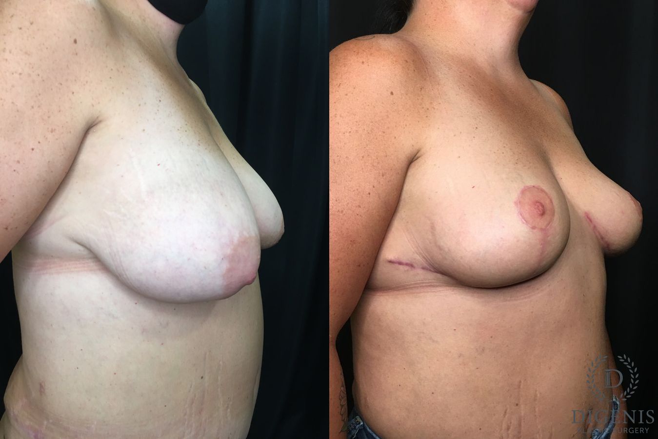 Before and after Breast Lift with or without Implants case 35181 - Angle 2