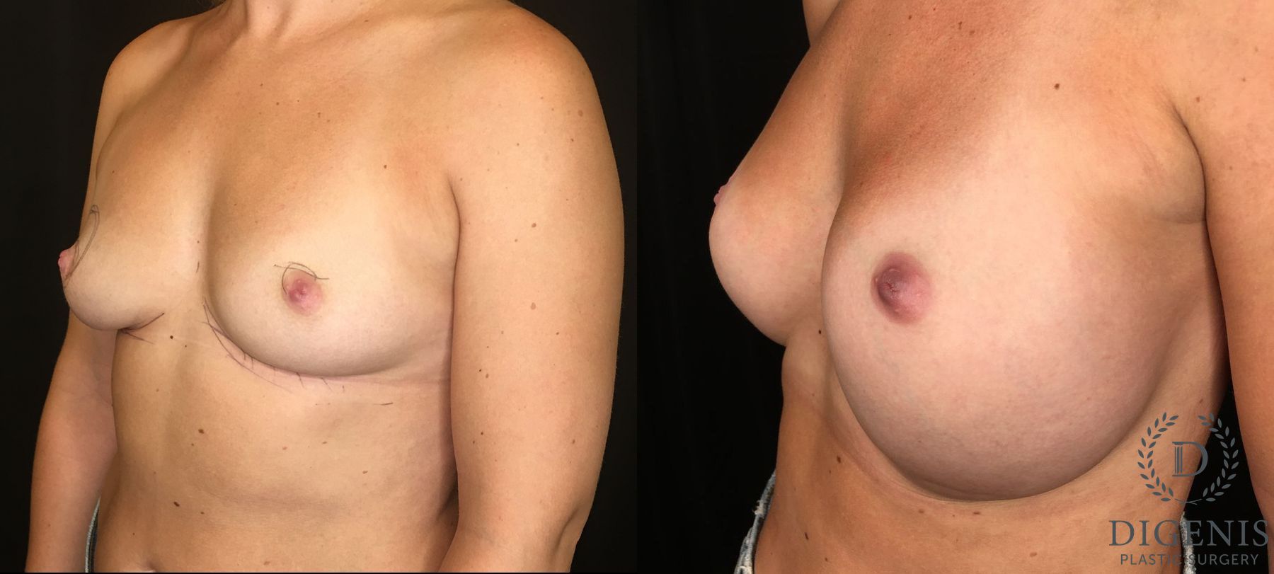 Before and after Breast Lift with or without Implants case 35168 - Angle 4