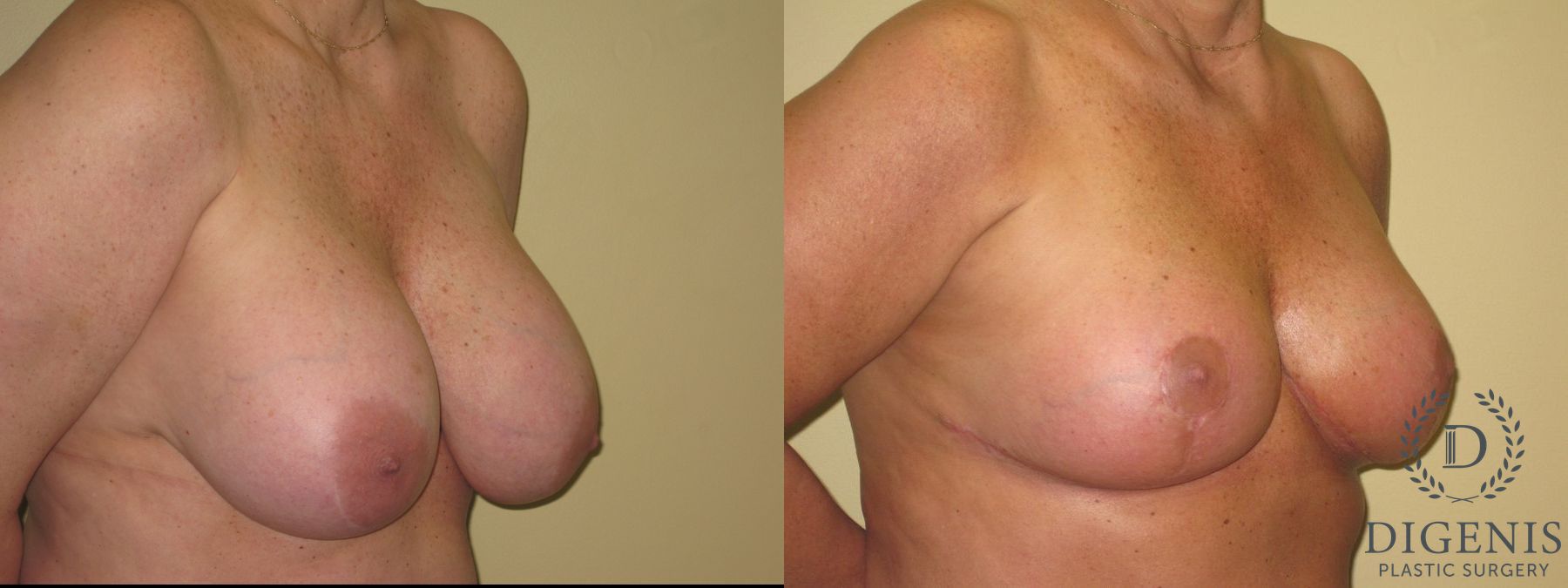 Before and after Breast Lift with or without Implants case 35105 - Angle 2