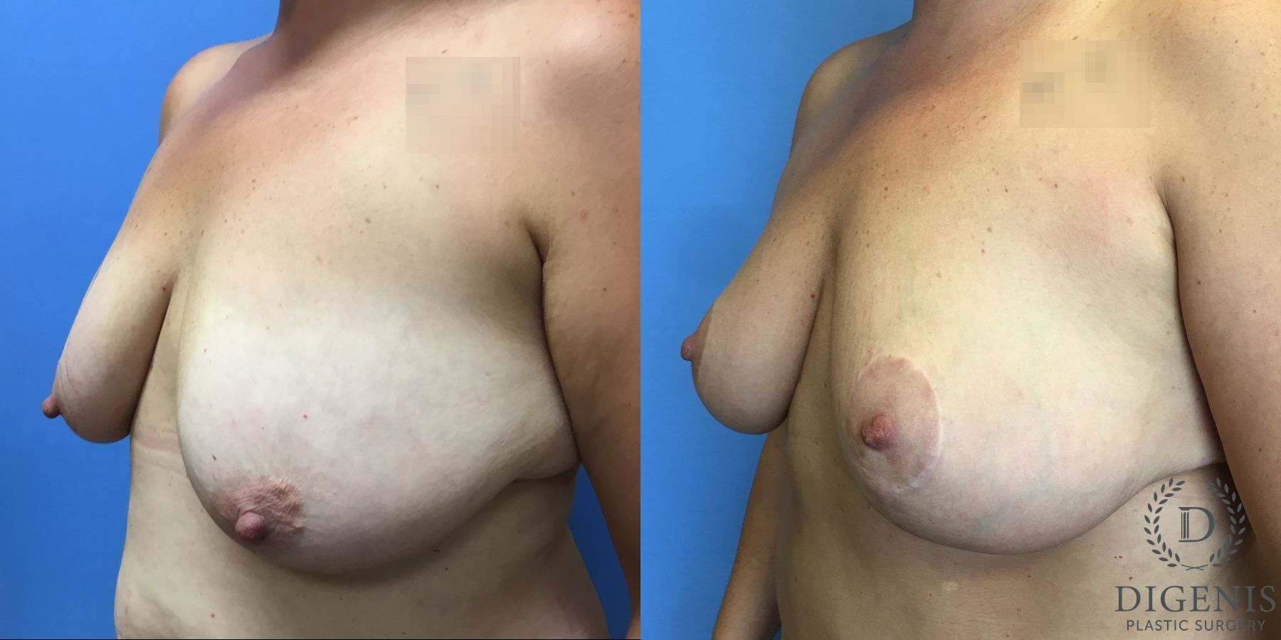 Before and after Breast Lift with or without Implants case 35144 - Angle 4