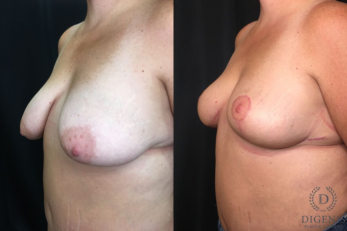 Before and after Breast Lift with or without Implants case 35181 - Angle 4