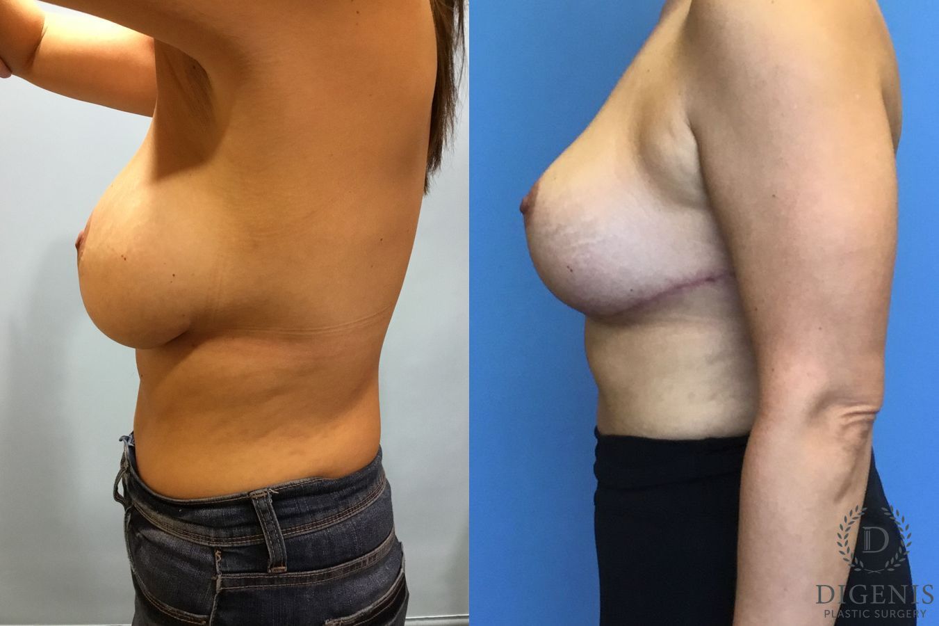 Before and after Breast Lift with or without Implants case 35058 - Angle 3