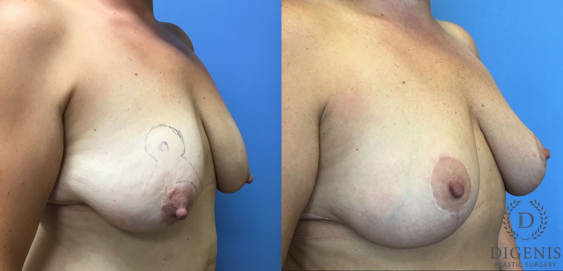 Before and after Breast Lift with or without Implants case 35144 - Angle 2