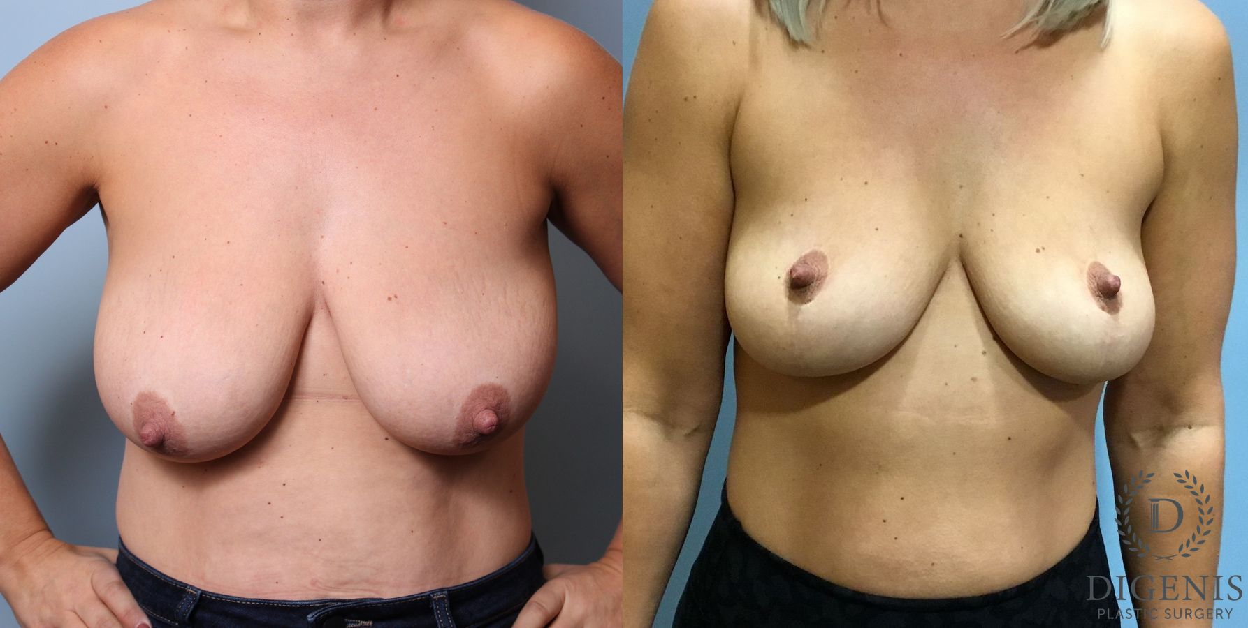 Before and after Breast Lift with or without Implants case 35111