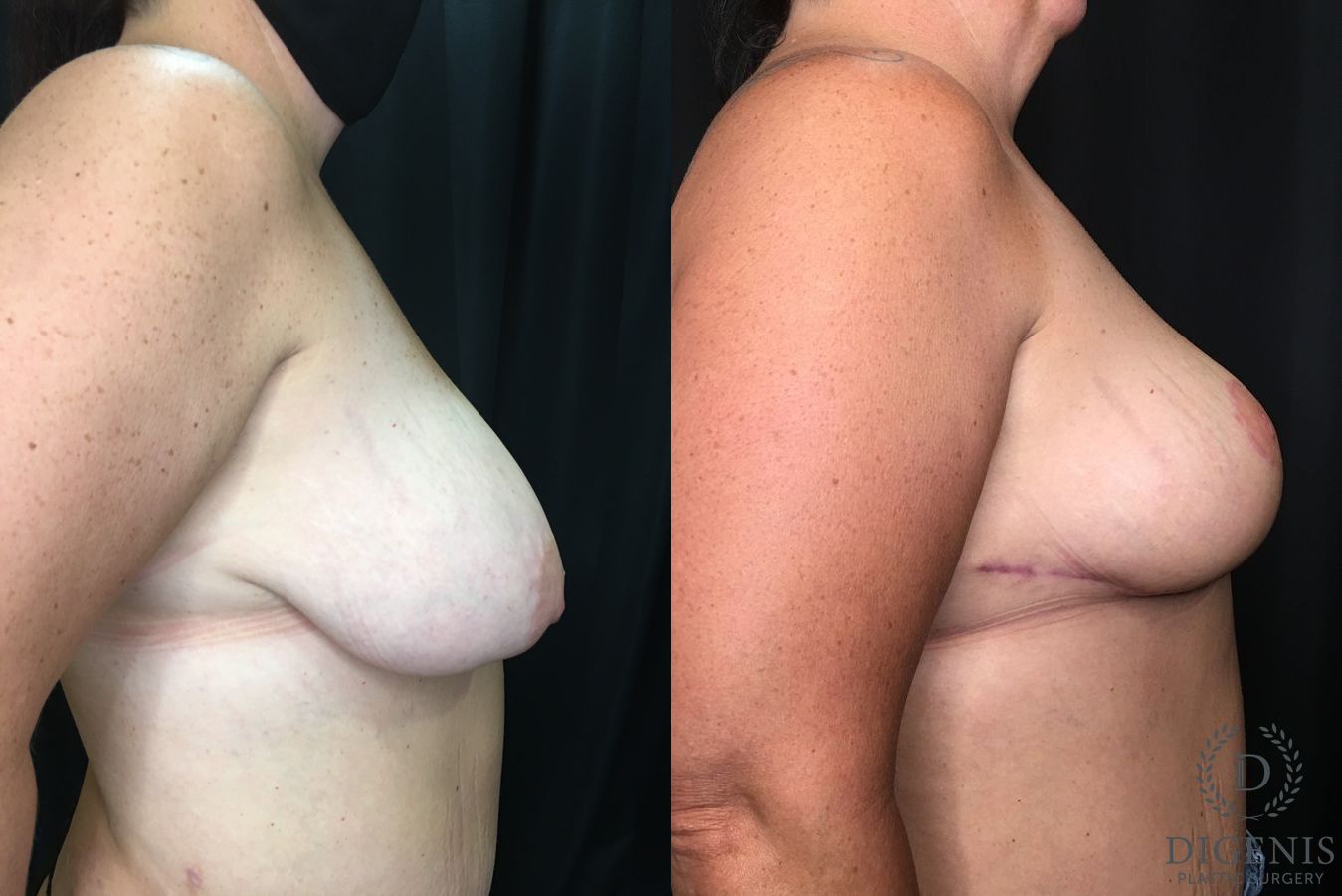 Before and after Breast Lift with or without Implants case 35181 - Angle 3