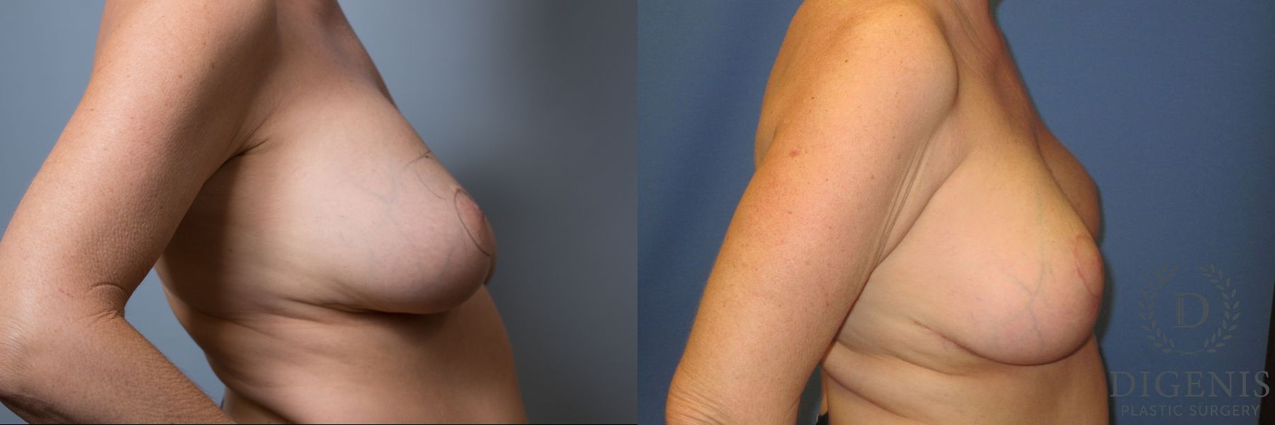 Before and after Breast Lift with or without Implants case 35133 - Angle 3