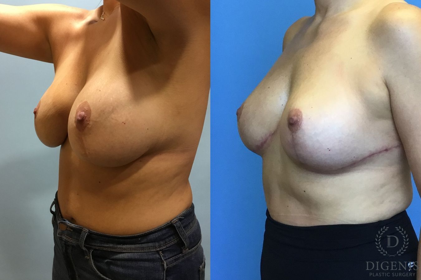 Before and after Breast Lift with or without Implants case 35058 - Angle 2