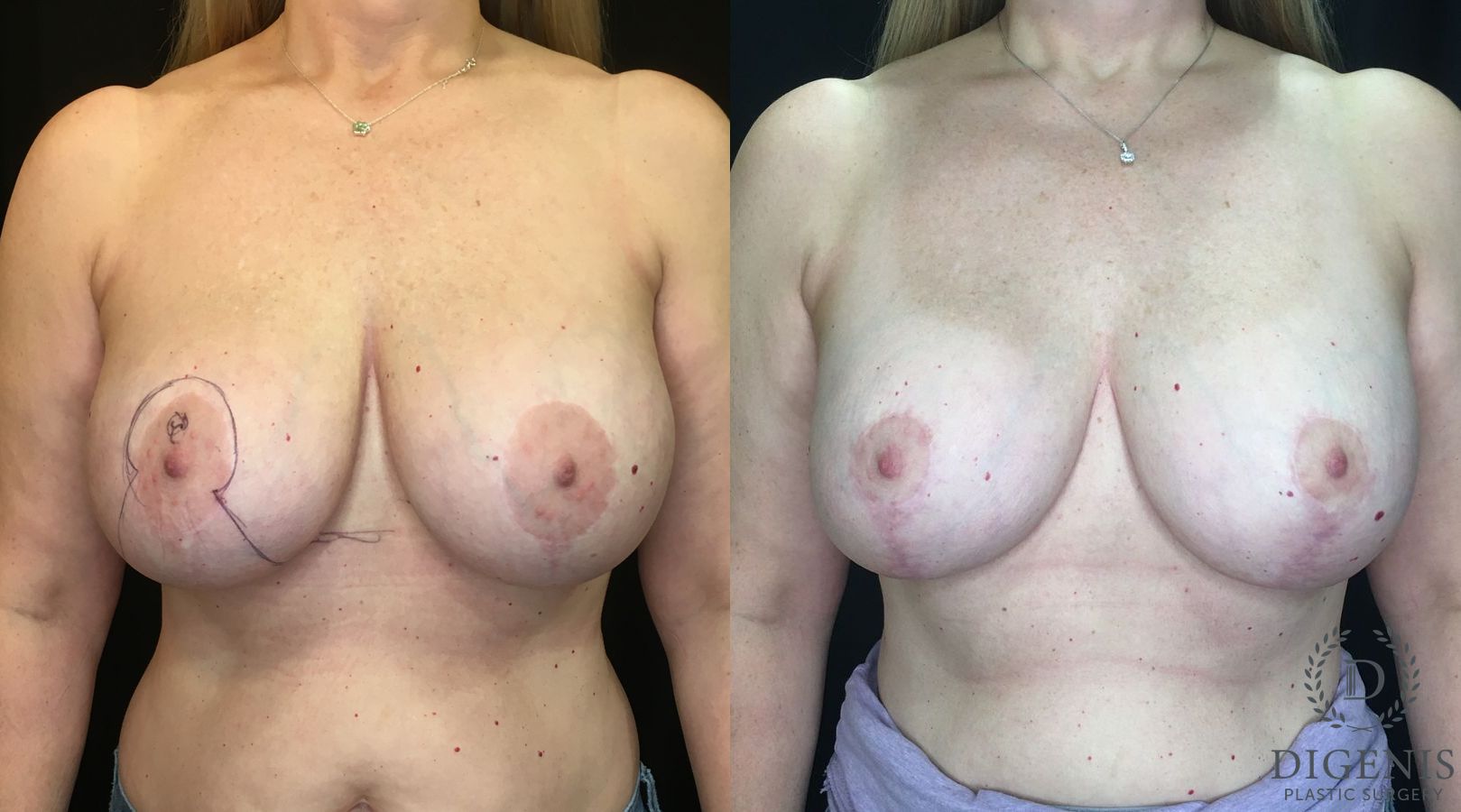 Before and after Breast Lift with or without Implants case 35156