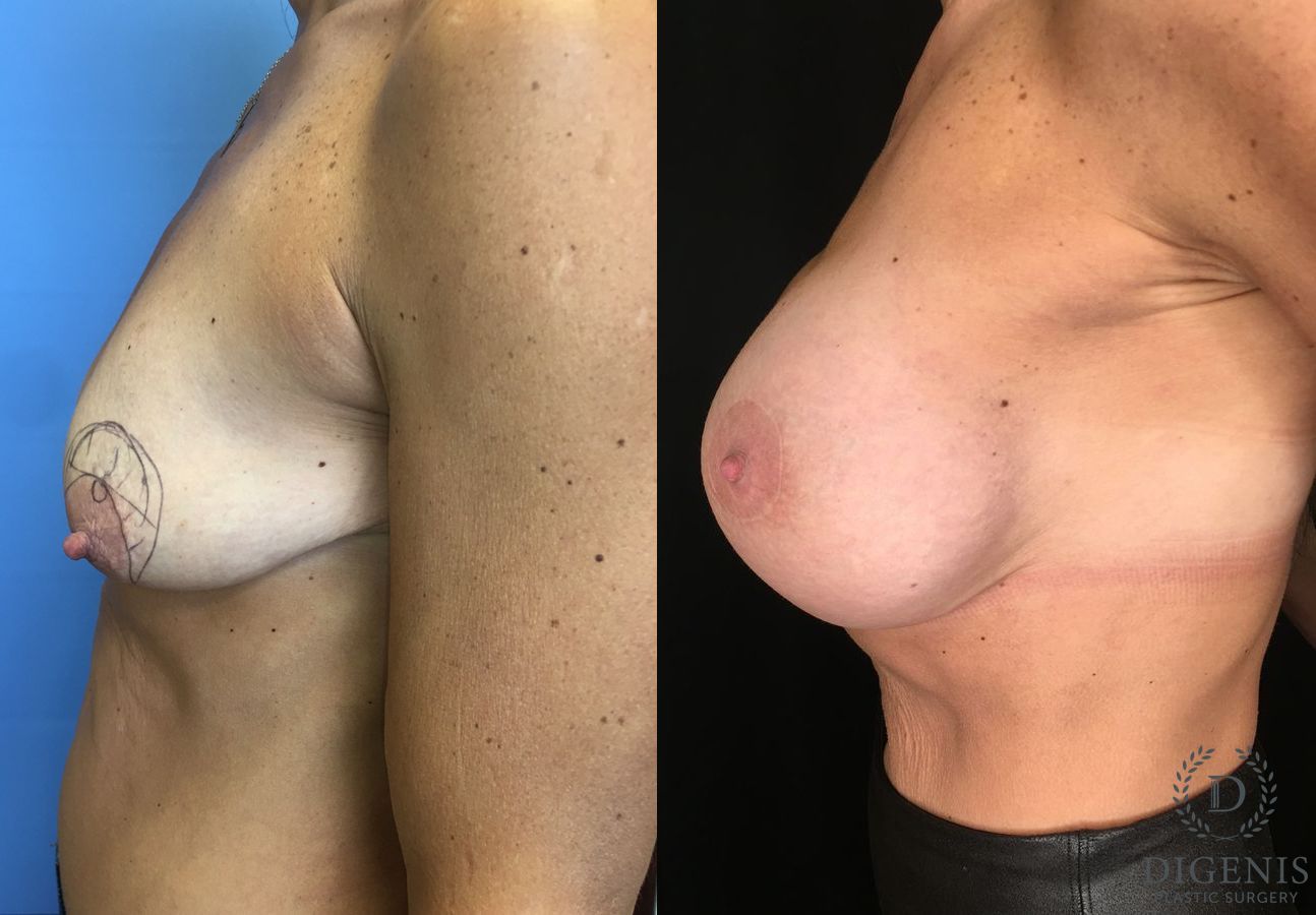 Before and after Breast Lift with or without Implants case 35196 - Angle 5