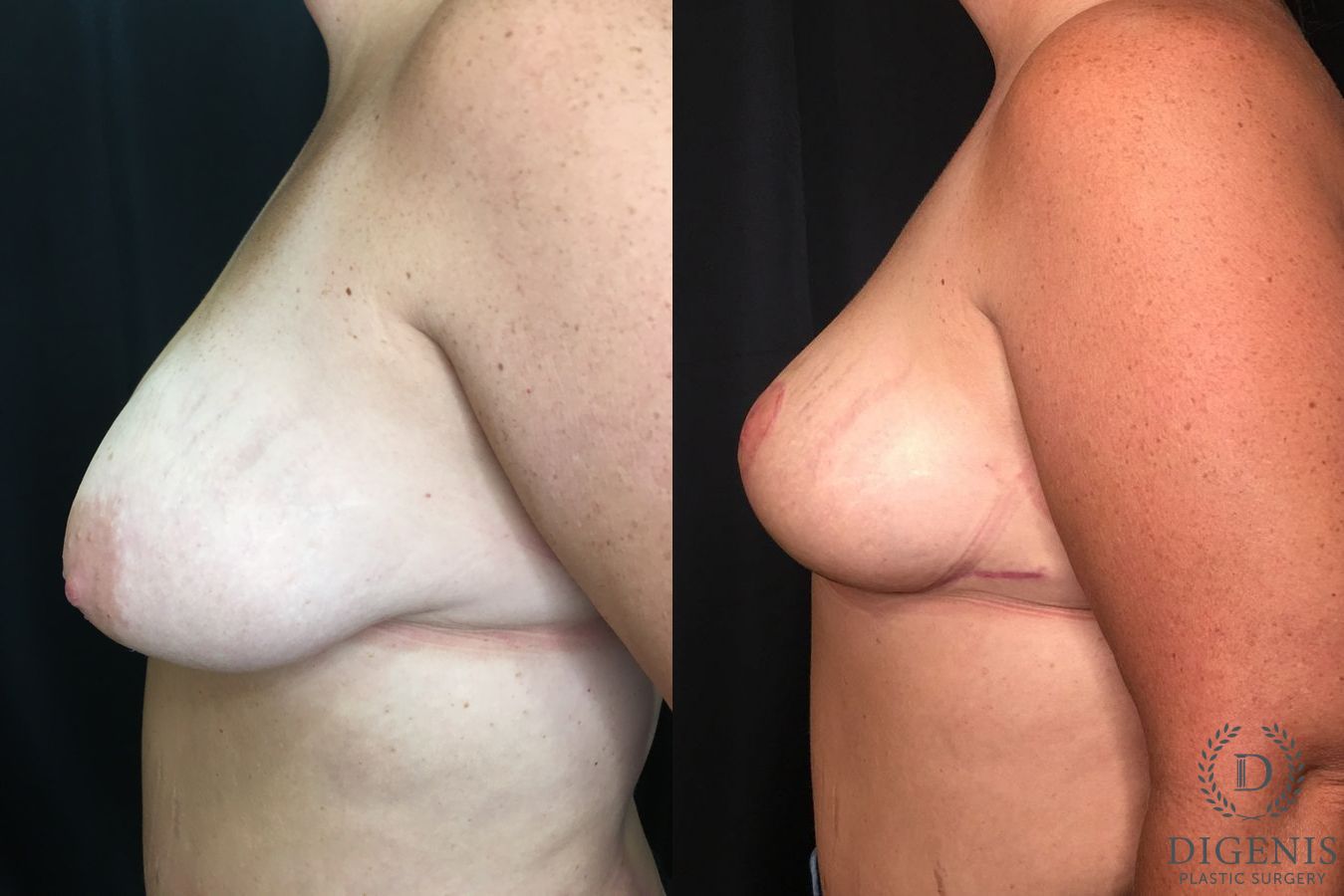 Before and after Breast Lift with or without Implants case 35181 - Angle 5