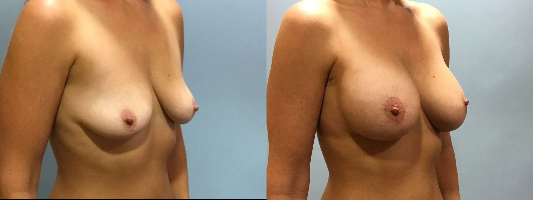 Before and after Breast Lift with or without Implants case 35093 - Angle 2