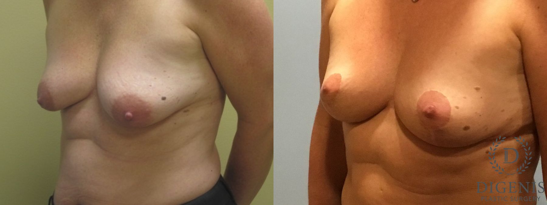 Before and after Breast Lift with or without Implants case 35140 - Angle 2
