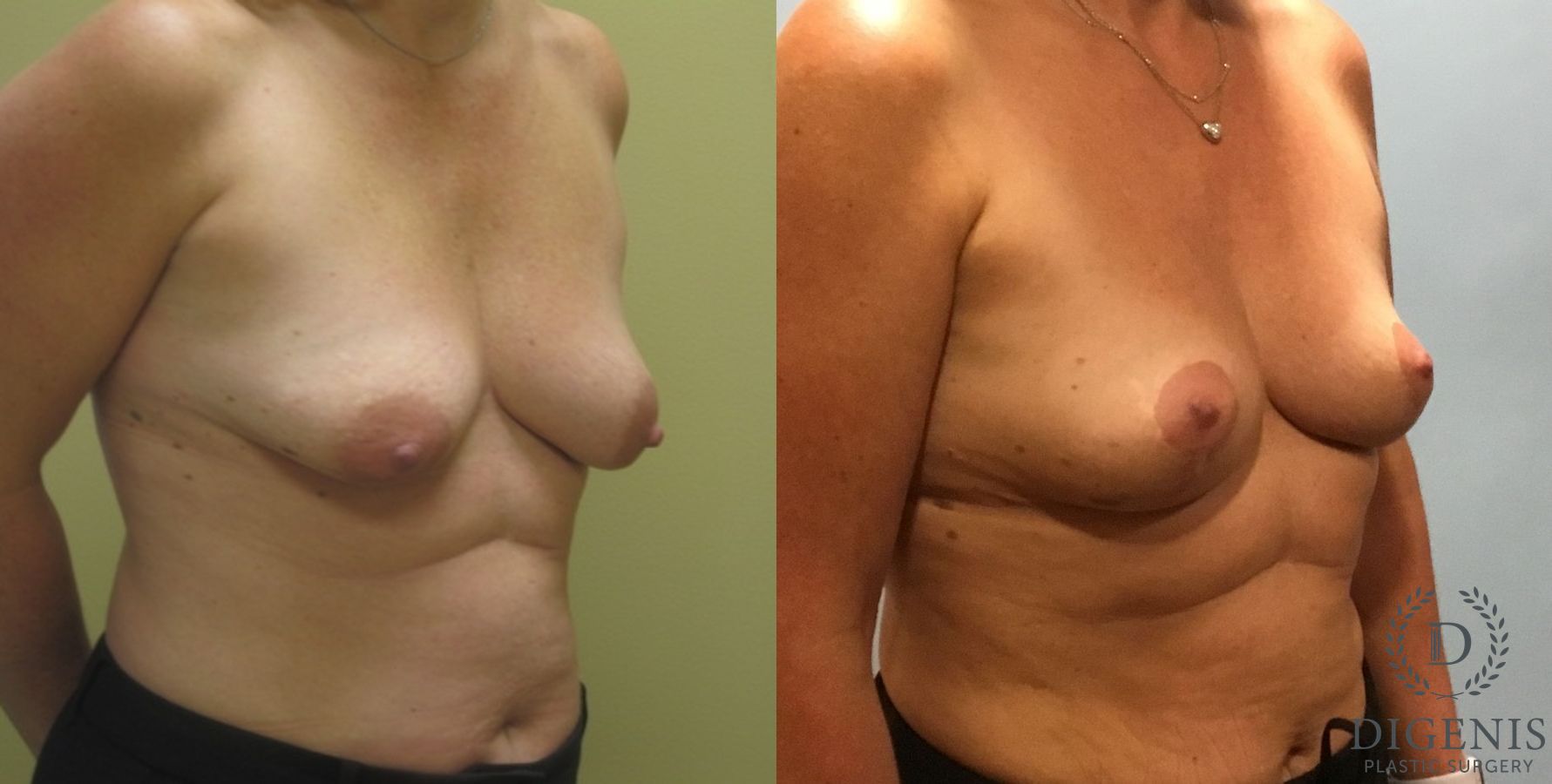 Before and after Breast Lift with or without Implants case 35140 - Angle 3
