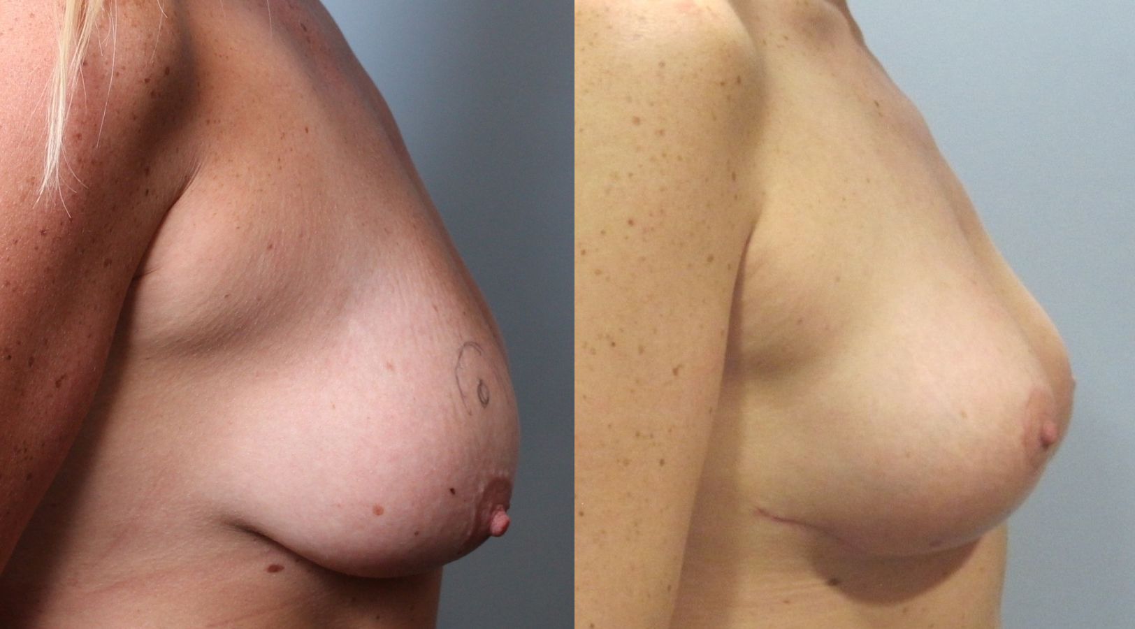 Before and after Breast Lift with or without Implants case 35132 - Angle 3