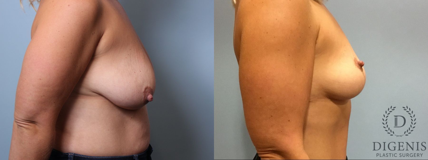 Before and after Breast Lift with or without Implants case 35111 - Angle 3